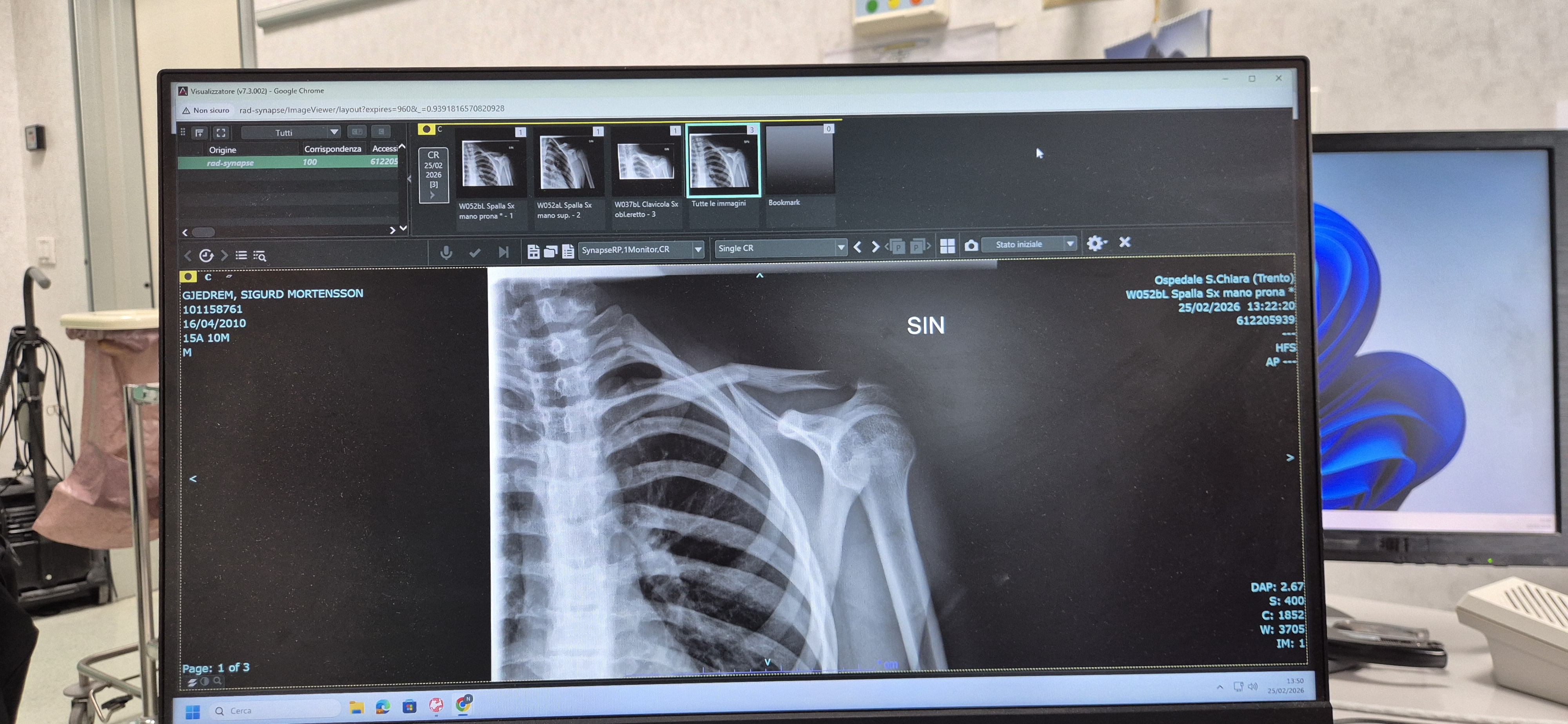 Røntgenbilde skulder